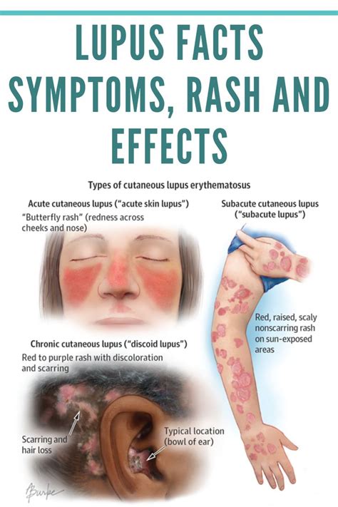 Lupus Facts Symptoms Rash And Effects Schoen Med In 2020 Lupus
