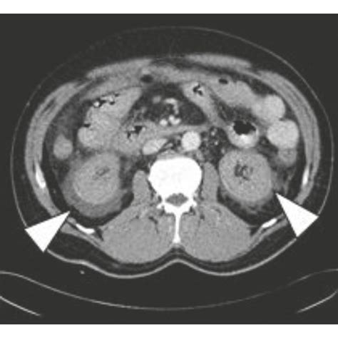 Contrast Enhanced Abdominal Ct Demonstrates Haemorrhage Of The Swollen