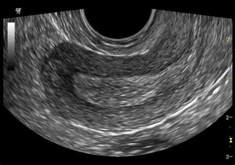 A pelvic ultrasound is a test that uses sound waves to make a picture of the organs and structures in the lower belly (pelvis). Normal gynaecological ultrasound - transvaginal | Image ...