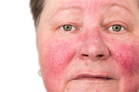 4400 Rosacea Stock Photos Pictures And Royalty Free Images Istock