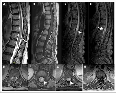 Figure 1 From Isolated Myelitis And Intramedullary Spinal Cord Abscess