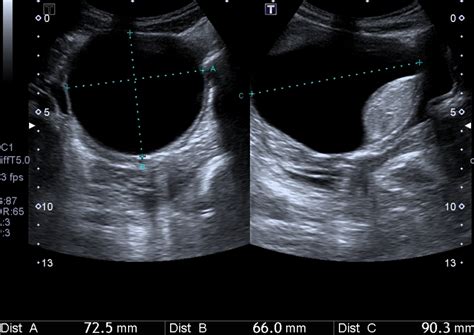 Hemorrhagic Ovarian Cyst Image