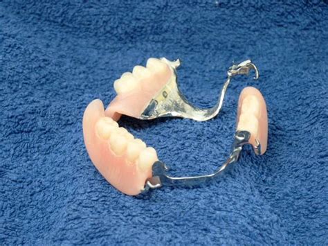 Semua gigi palsu lepasan memiliki kekurangan secara umum, yaitu: KLINIK PERGIGIAN SYARIFAH: Gigi Palsu Valplast dan Flexible