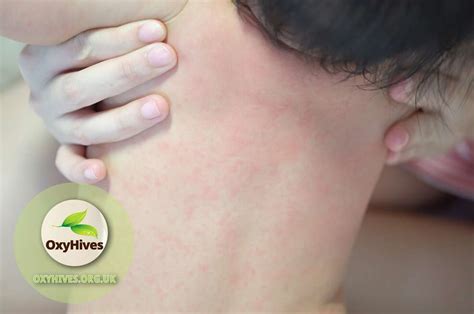 How To Treat Urticaria In Children Oxyhives Uk