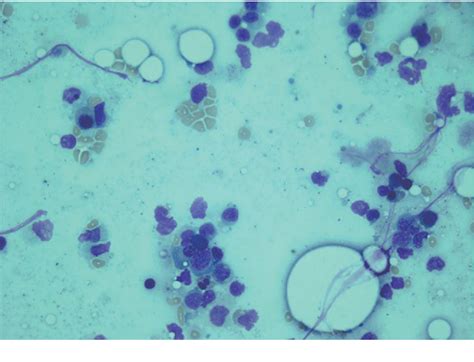 Figure 1 From T Cell Lymphoma Presenting As Drug Rash With Eosinophilia