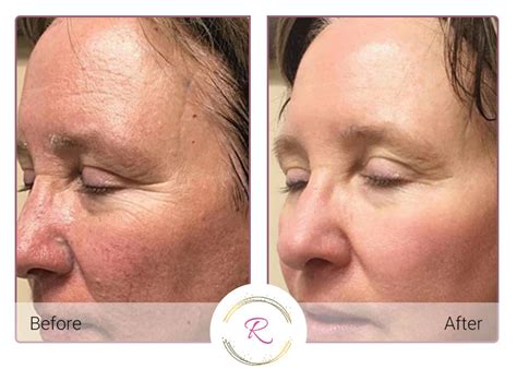 Clearlift Skin Resurfacing Revitalized Aesthetics And Beauty Bar