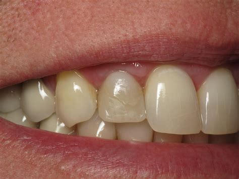 Shaping And Forming Gum Around Front Teeth Dental Implants Ramsey