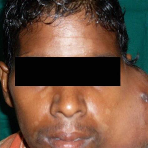 Clinical Photograph Of The Patient Showing Swelling Of The Left Parotid