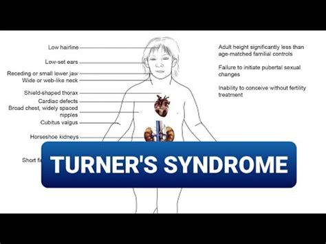 TURNER S SYNDROME X0 YouTube