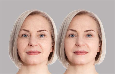 Nasolabial Folds Causes Treatment And Prevention Options To Try Yen