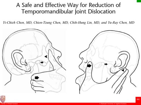 Subluxation And Dislocation Of Temporomandibular Joint Ppt