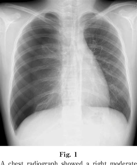 Pulmonary Metastasis Presenting With Pneumothorax In A Patient With