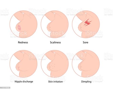 Irritation or dimpling of breast skin. Early Symptoms Of Breast Cancer Stock Illustration ...