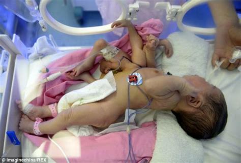 Baby Born With Headless Twin Four Hands Recovering After Surgery