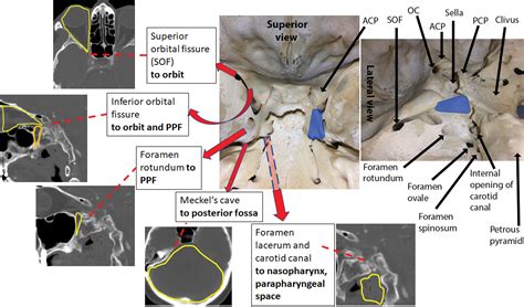 Imaging Spectrum Of Cavernous Sinus Lesions With Histopathologic