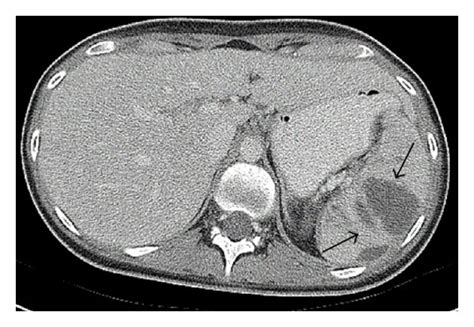 Splenic Abscesses Noted On Ct Scan Arrows Download Scientific Diagram