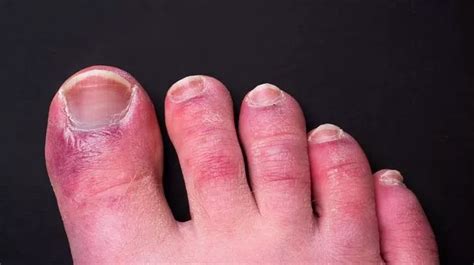 What Is Covid Toe What Causes It And How Can It Be Treated Mirror