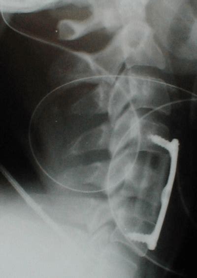 Cervical Spinal Stenosis Matthew D Hepler Md