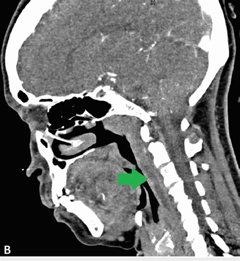 Contrast Enhanced Computed Tomography Ct Of The Neck Sagittal View