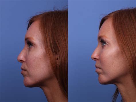 Cheek Implant Before And After Pictures Case Scottsdale Az