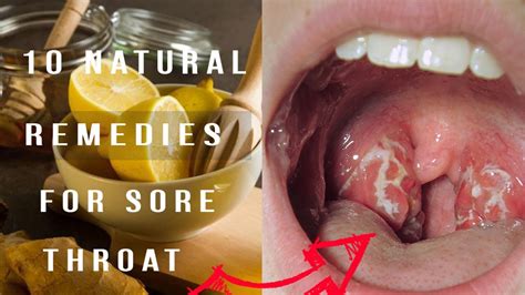 10 Natural Remedies For Sore Throat Youtube