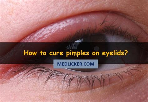 Pimples On Eyelids Causes Symptoms Treatment And Prevention