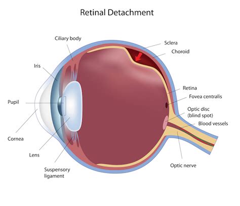 Retinal Tears and Detachments - La Pine Eyecare Clinic