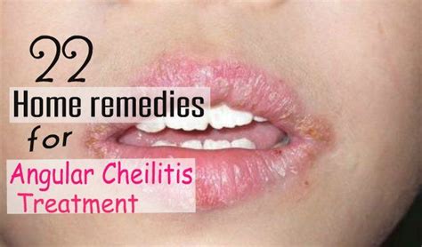 22 Effective Home Remedies For Angular Cheilitis Treatment