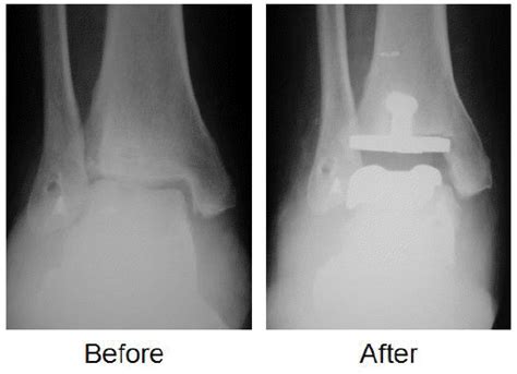 Total Ankle Replacement Los Angeles Total Ankle Arthroplasty Los Angeles