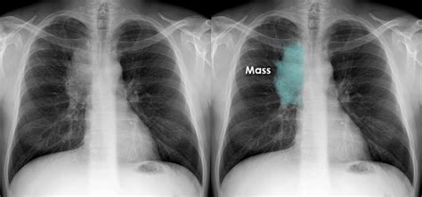 Chest X Ray Lung Cancer Progressive Disease