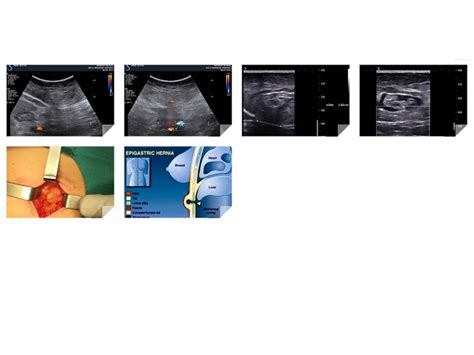 Vietnamese Medic Ultrasound Case 421 Epigastric Hernia Dr Phan Thanh