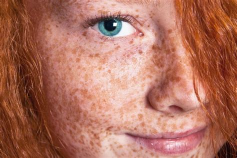 How Long Do Freckles Take To Fade