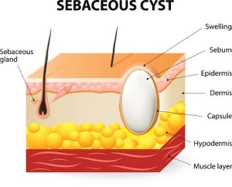 Are you sure it is just an ingrown, i.e. Sebaceous Cyst removal in Norwich | Sebaceous Cyst Removers