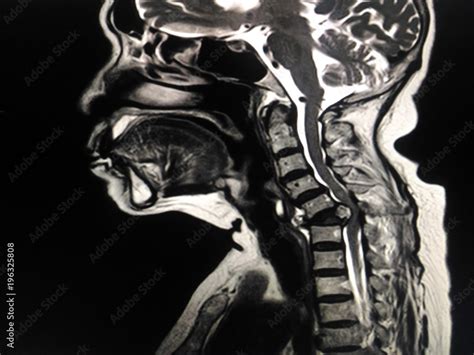 Mri Cervical Spine A Human Showing Mass Or Tumor In Bone Neck Stock Photo Adobe Stock
