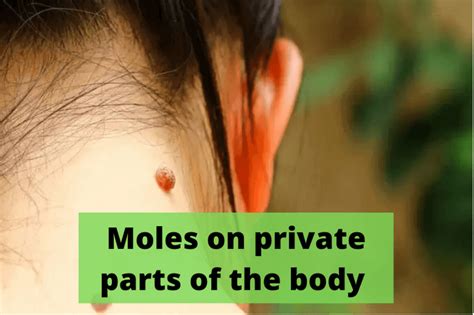 How To Remove Moles From The Private Part Of The Body