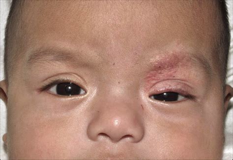 Topical Treatment For Capillary Hemangioma Of The Eyelid Using β