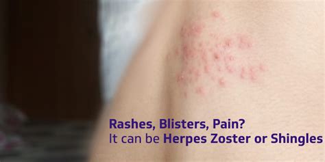Rashes Blisters Pain It Can Be Herpes Zoster Or Shingles Rxdx