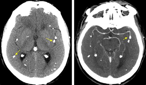 Axial Brain Ct Before A And After Injection Of Iodine Contrast Media
