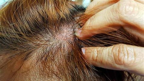 Itchy Red Spots On Scalp