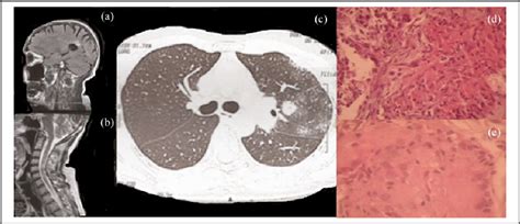 Figure 1 From Pulmonary Paracoccidioidomycosis Associated With The Use