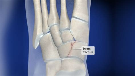 Navicular Stress Fracture Top Of Foot