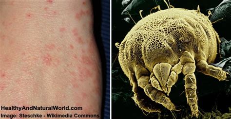 Mite Bites Warning Signs And Natural Treatments