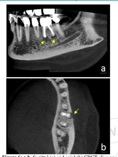 Pdf Cone Beam Computed Tomography In The Diagnosis Of Chronic Apical