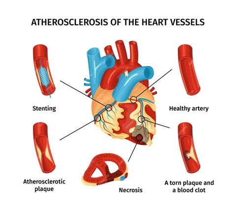Free Vector Atherosclerosis Of Heart Vessels Flat Infographic With