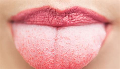 What Causes The White Coating On Your Tongue | Centre Dentaire St. Laurent