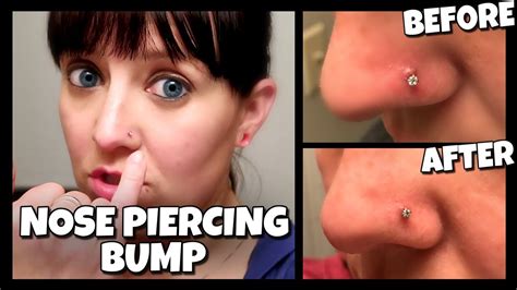 How To Get Rid Of A Nose Piercing Bump Fast Keloid 📍 How To With Kristin Youtube