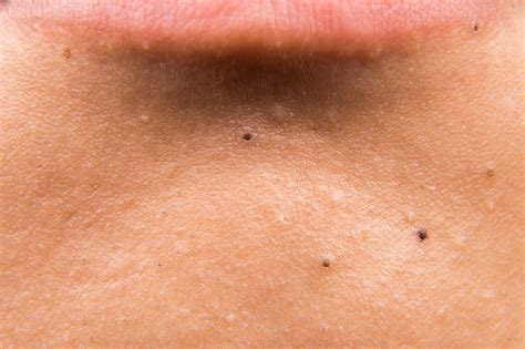 Black Dots On Skin