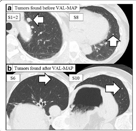 Chest Computed Tomography Images Of Pulmonary Nodules A Chest Computed