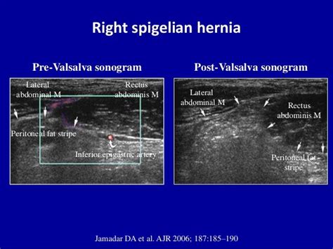 Inguinal Hernia Ultrasound Landmarks