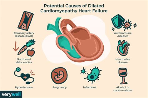 Dilated Cardiomyopathy Symptoms Causes Diagnosis And Treatment